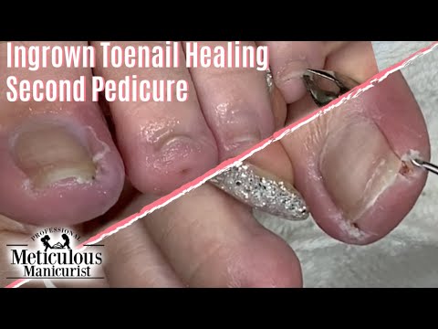 , title : '👣 How To Heal Ingrown Toenail at Home Salon Pedicure Second Visit 👣