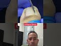 COLOSSAL INGROWN TOENAIL Shorts Ingrowntoenail