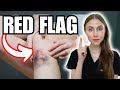 Bruising Easily? Here Are the Red Flags