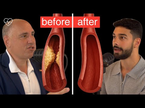 #1 Heart Surgeon: This is What You Should Do To REVERSE PLAQUE | Dr. Philip Ovadia, MD, ep. 014