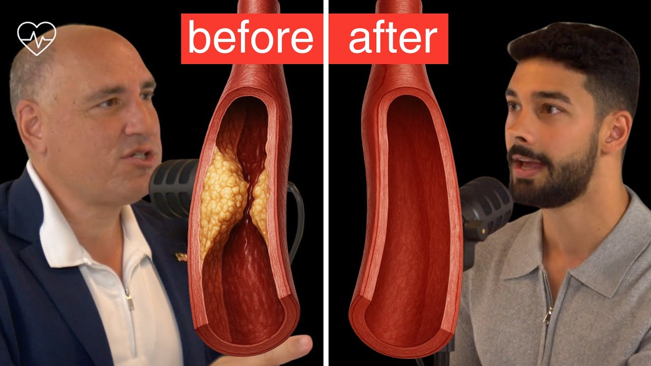 #1 Heart Surgeon: This is What You Should Do To REVERSE PLAQUE | Dr. Philip Ovadia, MD, ep. 014