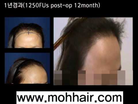 1350FU's. Female Hairline Correction. Hair Transplantation by Dr. Moh