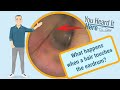 Earwax Hairy Ears A MESS The Patient Is Hearing The Hair In Their Ears