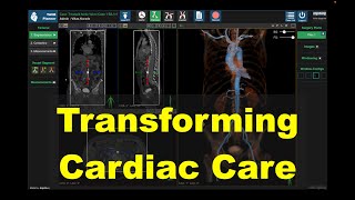 A glimpse of #ai based #3d #tavr planning software by #AlgoSurg Inc.