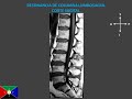 ESTUDIO DE LA COLUMNA VERTEBRAL POR RESONANCIA MAGNÉTICA INTERPRETACIÓN MORFOLÓGICA