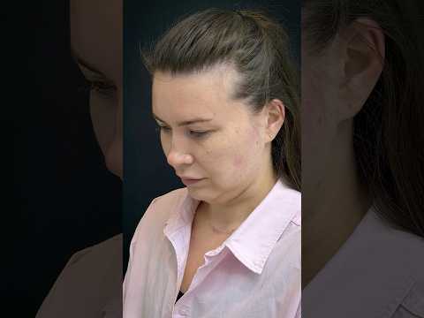 Skin Tightening Treatment