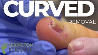 Curvy Ingrown Nail