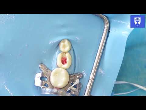 Technique for Primary Molar Tooth Pulpotomy