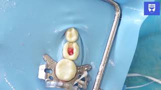 Download lagu Technique for Primary Molar Tooth Pulpotomy mp3