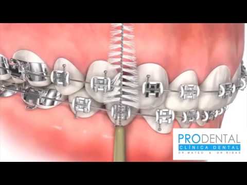 ¿Cómo lavarse correctamente los dientes con brackets?