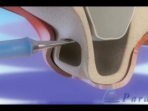 상악동 상승 (Sinus Lift) ©