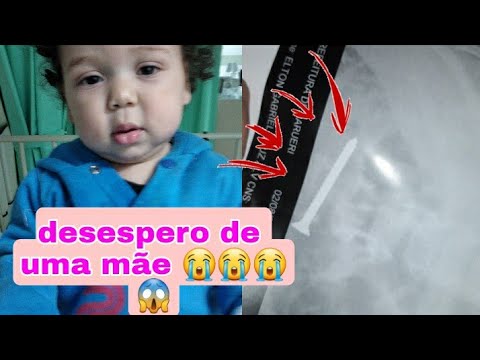 Meu filho ta enternado engoliu um parafuso