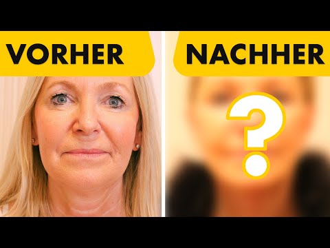 Ich zeige endlich das Facelift Ergebnis meiner 51-jährigen Patientin! | Dr. Jungwirth