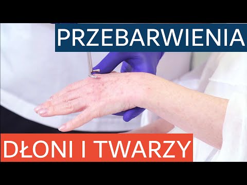 Usuwanie przebarwień skóry na dłoniach i twarzy laserem pikosekundowym Discovery Pico