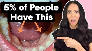 Do You Have These In Your Mouth? (Mandibular Tori Explained)