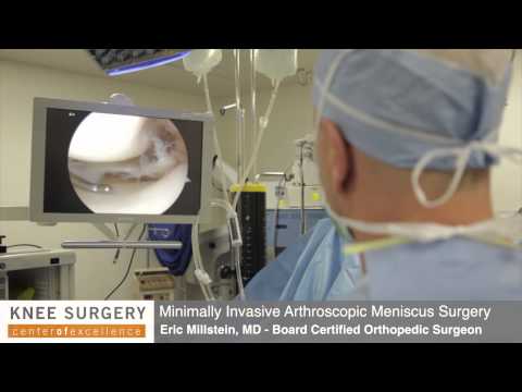 Arthroscopic knee surgery/ meniscus surgery performed by dr....