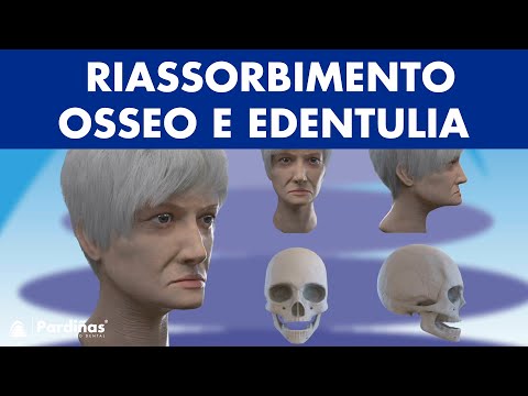 Edentulia e riassorbimento osseo ©