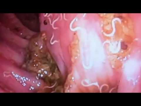 szex pinworms