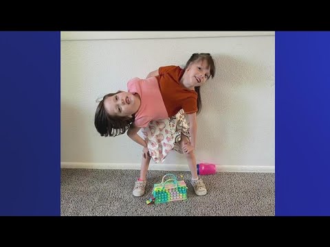 7's HERO: Idaho conjoined twins Callie and Carter are beating the odds
