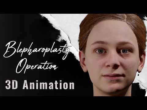Blepharoplasty Surgery: Revitalize Your Eyes with 3D Animation
