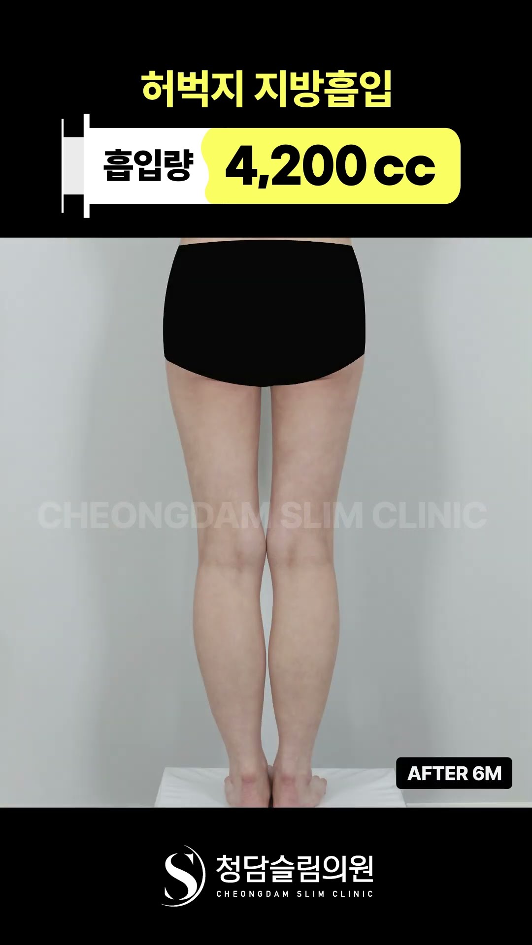 허벅지 사이 남남된 사연