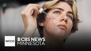 What parents of teens need to know about acne and what they can do about it