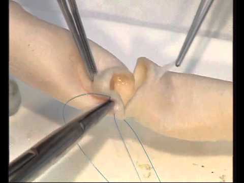 Transverse Aortotomy and double layer closure CABG Cardiac Surgery