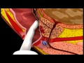Prostate Cancer 3D Medical Animation ABP