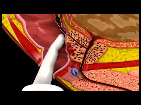 A prostatitis 5