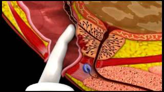 Prostate Cancer - 3D Medical Animation  ABP ©
