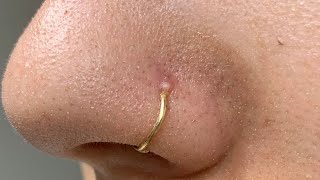 how to get rid of white bump on nose piercing
