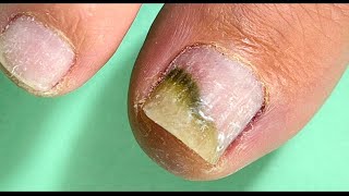 Eine unangenehme Überraschung unter dem Gellack😱!