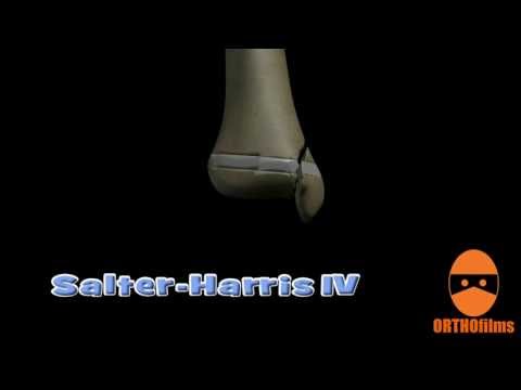 Salter-Harris Fractures