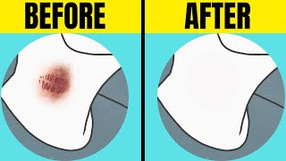 HOW to GET RID of Hickeys: PROVEN Removal Techniques !!