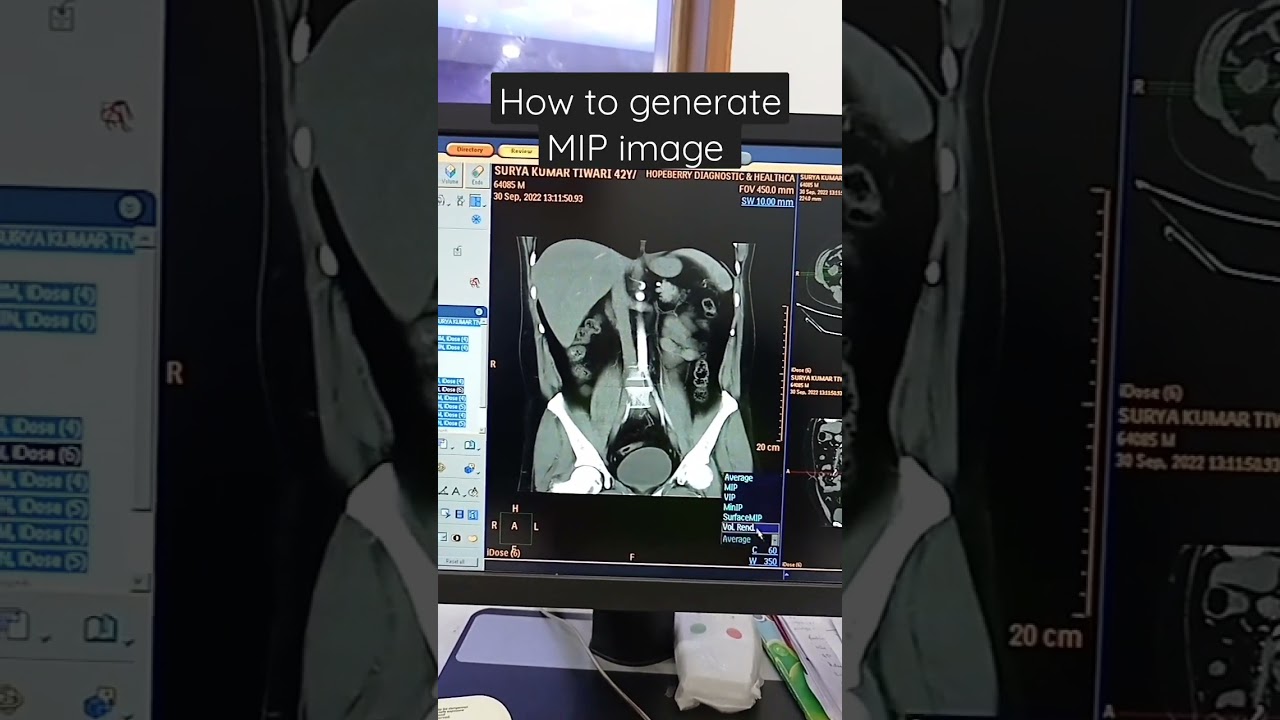 how to generate MIP images. #philips #angiography #planning #ctscan