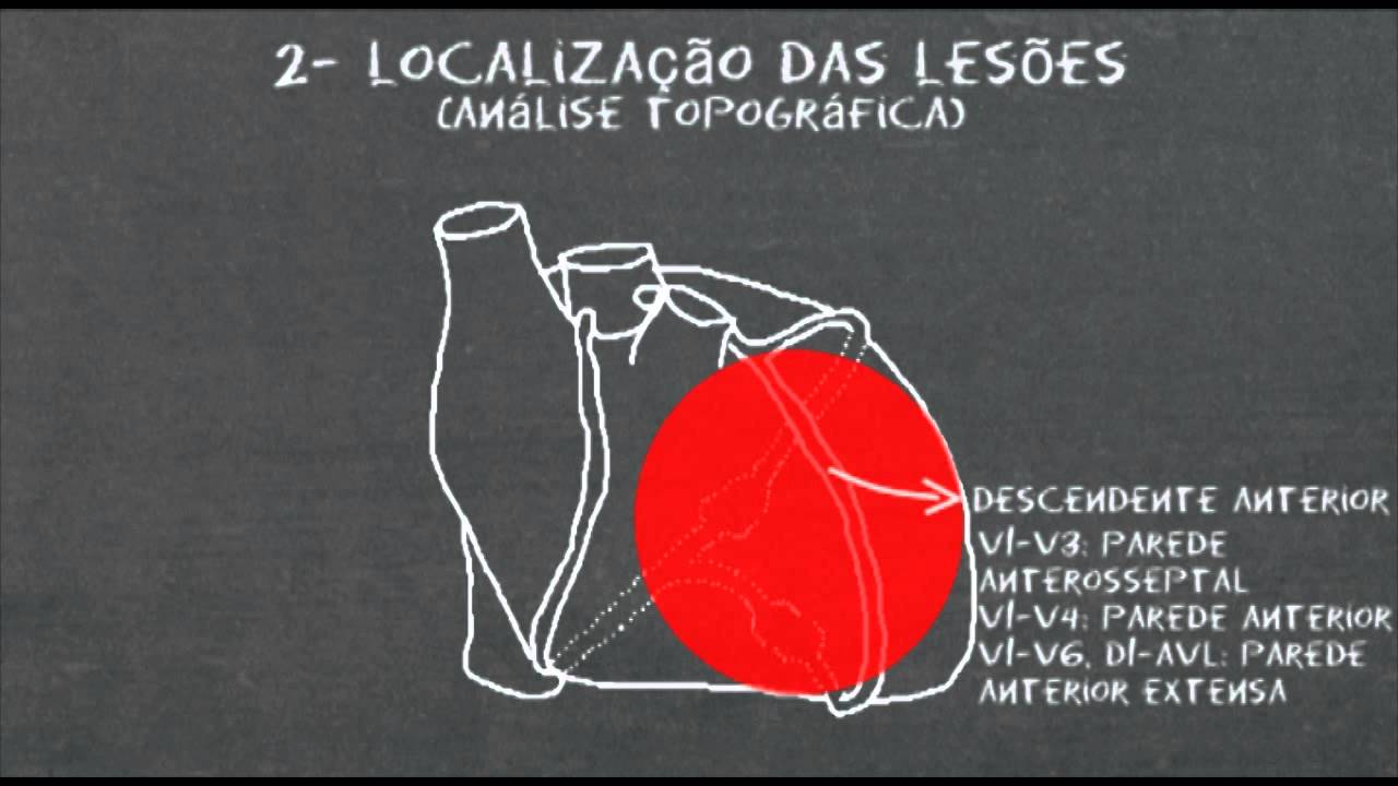 Eletrocardiograma no infarto agudo do miocárdio - parte1