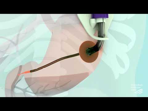 Gelderse Vallei Voeding PEG-J (Percutane, Endoscopische, Gastrostomie, Jejunumsonde) sonde