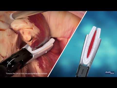 Left Atrial Appendage Clip Pre-surgical Education