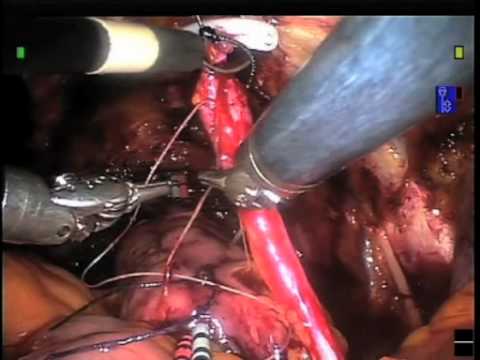 Laparoscopic Intracorporeal Urinary Diversion - Robot Assistance