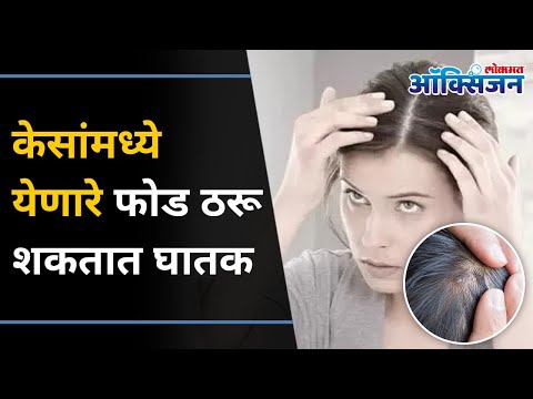 , title : 'केसांमध्ये येणारे फोड असे करा नाहीसे | Pimples On Scalp | How to Treat Acne On Scalp| Hair Treatment'