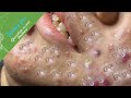 (Acne Treatment for Ha Part 1) - Make Your Day Relaxing with Windy Spa 6#211 (Acne Treatment for Ha Part 1) - Make Your Day Relaxing with Windy Spa 6#211