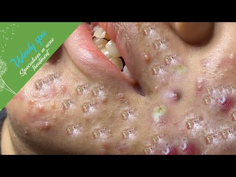 (Acne Treatment for Ha Part 1) – Make Your Day Relaxing with Windy Spa 6#211