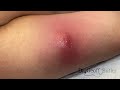 Drainage of an arm abscess