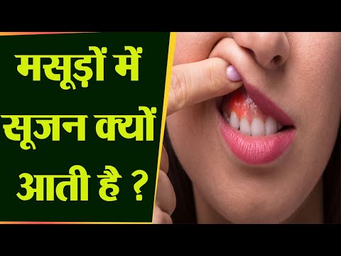 मसूड़ों में सूजन क्यों होता है | Masudo Mein Sujan Kyu Hota Hai | Boldsky