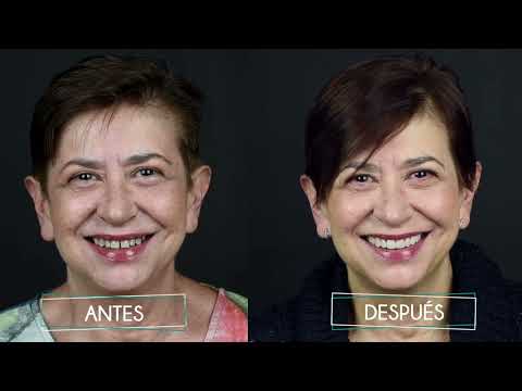 CARILLAS DE ALTA ESTÉTICA | EXPERIENCIA REAL | ORIÓN DENTAL | MADRID