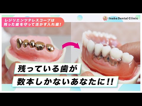 残っている歯が数本しかないあなたに！〜レジリエンツ テレスコープは残った歯を守って活かす入れ歯です〜