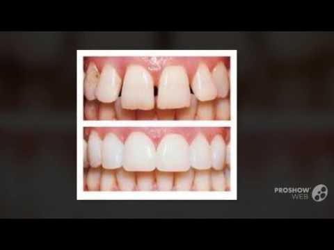 download lagu mp3 mp4 Teeth Whitening Coventry, download lagu Teeth Whitening Coventry gratis, unduh video klip Teeth Whitening Coventry