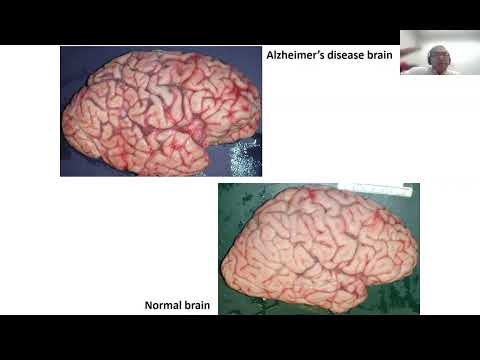 AANP Teaching Rounds - September 26 - Alzheimer's Disease and Common Co-Morbidities