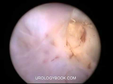 Holmium Laser Enucleation Of Prostate 3/9