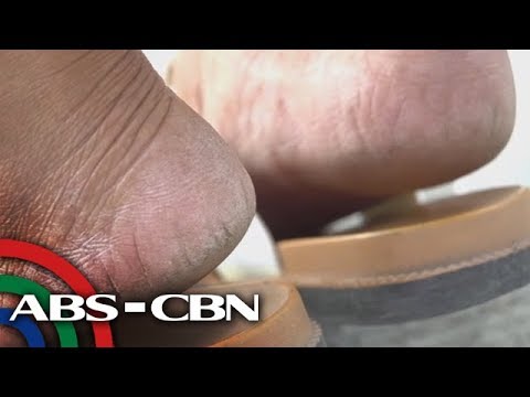 Kung paano gamutin ang kuko halamang-singaw suka Halamang-singaw sa kanyang mga paa pus